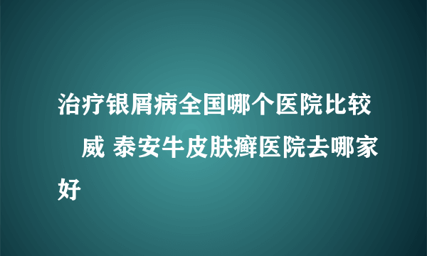 治疗银屑病全国哪个医院比较權威 泰安牛皮肤癣医院去哪家好