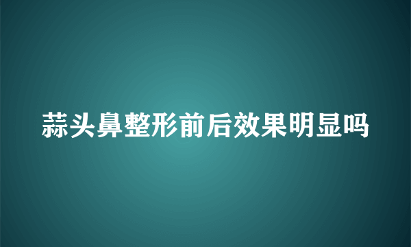 蒜头鼻整形前后效果明显吗