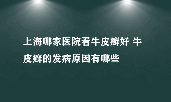 上海哪家医院看牛皮癣好 牛皮癣的发病原因有哪些