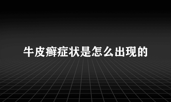 牛皮癣症状是怎么出现的