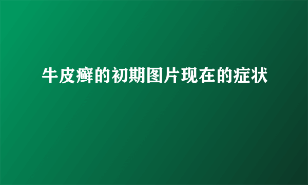 牛皮癣的初期图片现在的症状