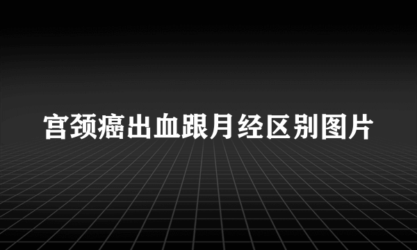 宫颈癌出血跟月经区别图片