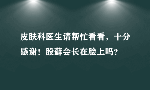 皮肤科医生请帮忙看看，十分感谢！股藓会长在脸上吗？