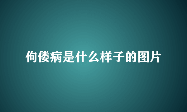 佝偻病是什么样子的图片