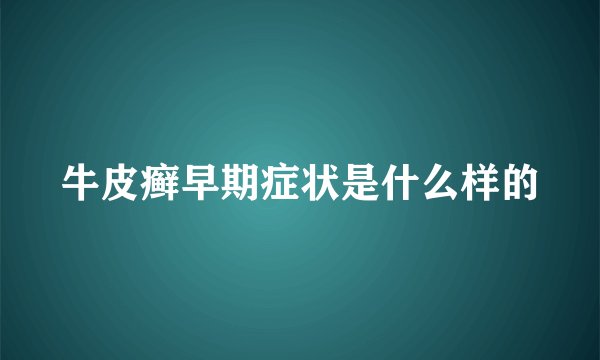 牛皮癣早期症状是什么样的